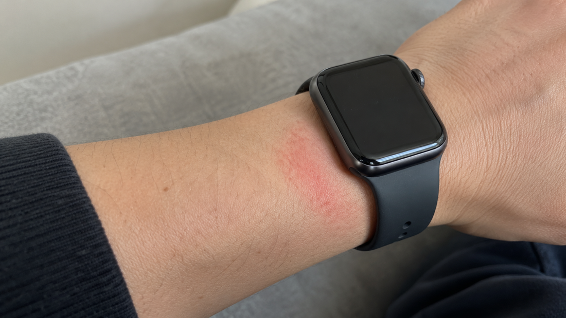 Rode plek op pols door het dragen van een smartwatch